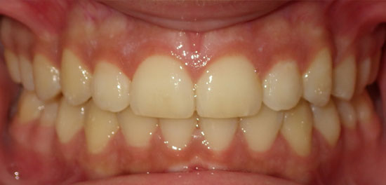 Invisalign