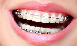 clear braces